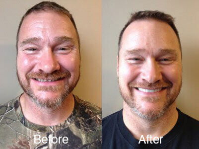 Smiling man before and after cosmetic dental surgery