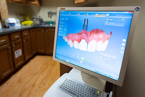 Cerec Sirona screen