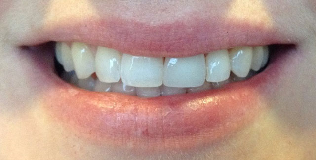 Cosmetic Dentistry After Smile