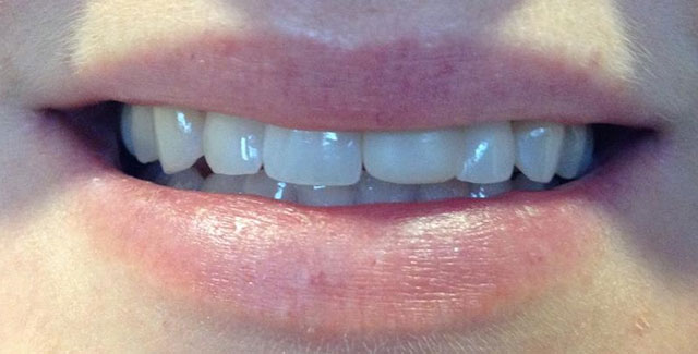 Cosmetic Dentistry Before Smile