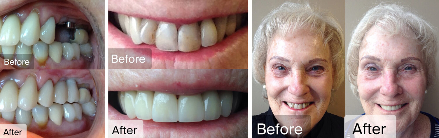 Row of Before and After Cosmetic Dentistry photos