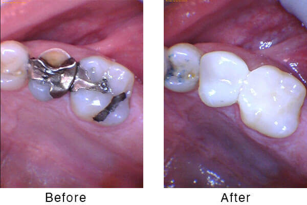 Dental Crowns Before and After