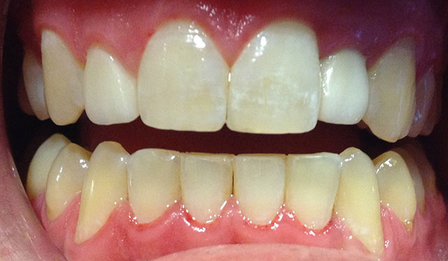 Teeth After Dental Implants
