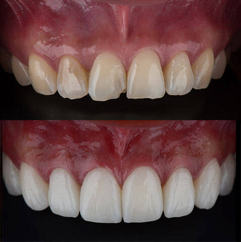 Veneers Before and After